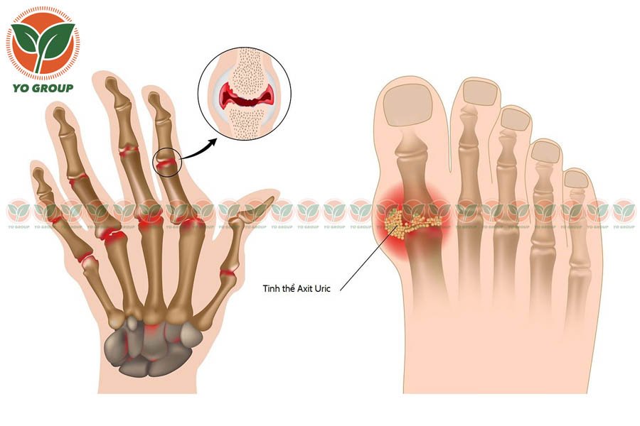 Bệnh Gout Có Chữa Được Không? Chuyên Gia Giải Đáp 2 Bệnh Gout Có Chữa Được Không? Chuyên Gia Giải Đáp