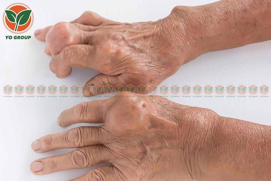 Bệnh Gout Có Chữa Được Không? Chuyên Gia Giải Đáp 4 Bệnh Gout Có Chữa Được Không? Chuyên Gia Giải Đáp