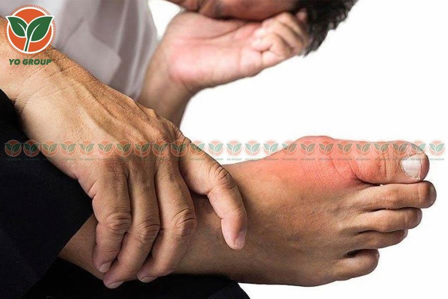 Bệnh Gout Có Chữa Được Không? Chuyên Gia Giải Đáp 5 Bệnh Gout Có Chữa Được Không? Chuyên Gia Giải Đáp