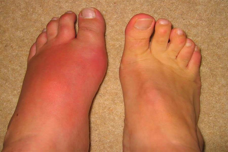 Dấu Hiệu Bệnh Gout Ở Chân Cần Lưu Ý Để Chữa Trị Kịp Thời