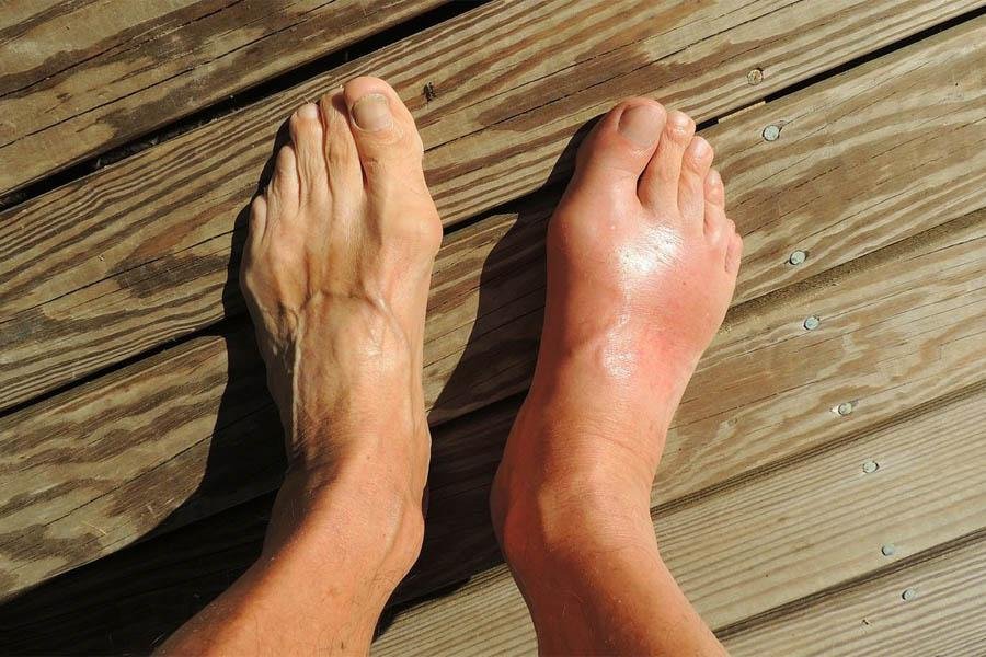 Tìm Hiểu Những Nguyên Nhân Bệnh Gout Và Biến Chứng 6 Tìm Hiểu Những Nguyên Nhân Bệnh Gout Và Biến Chứng