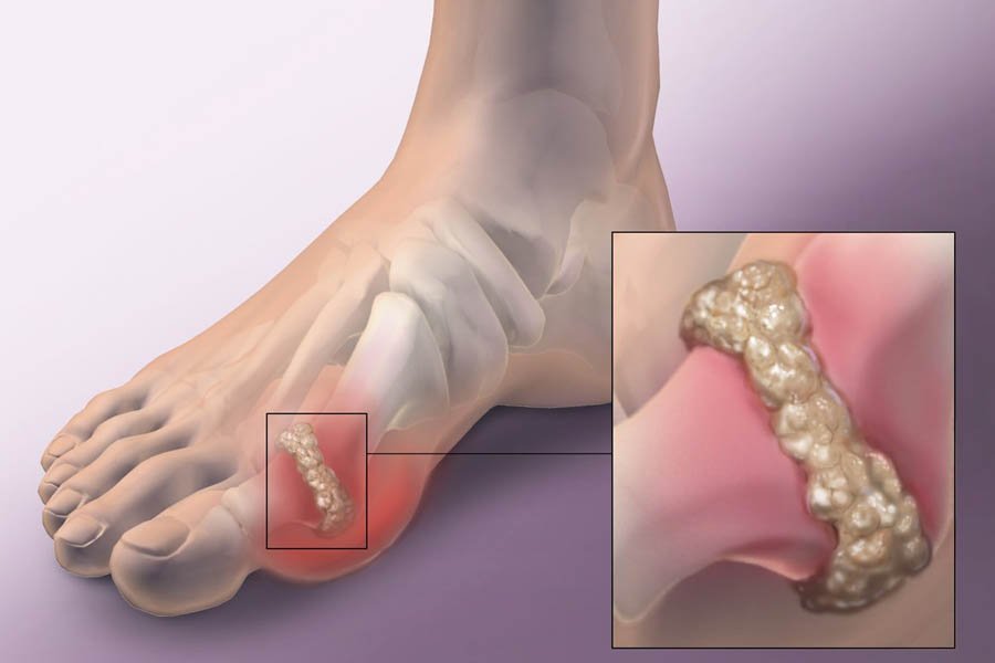 Tìm Hiểu Những Nguyên Nhân Bệnh Gout Và Biến Chứng 4 Tìm Hiểu Những Nguyên Nhân Bệnh Gout Và Biến Chứng