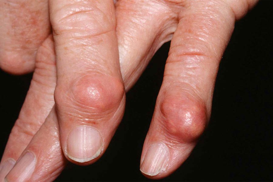 Tìm Hiểu Những Nguyên Nhân Bệnh Gout Và Biến Chứng 2 Tìm Hiểu Những Nguyên Nhân Bệnh Gout Và Biến Chứng