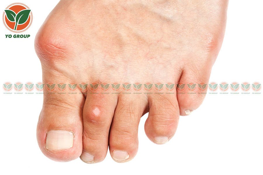 Top 8 Loại Thuốc Trị Gout Được Bác Sĩ Chỉ Định Nhiều Nhất 2 Top 8 Loại Thuốc Trị Gout Được Bác Sĩ Chỉ Định Nhiều Nhất